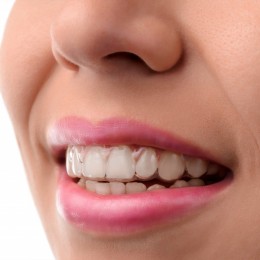 Invisalign