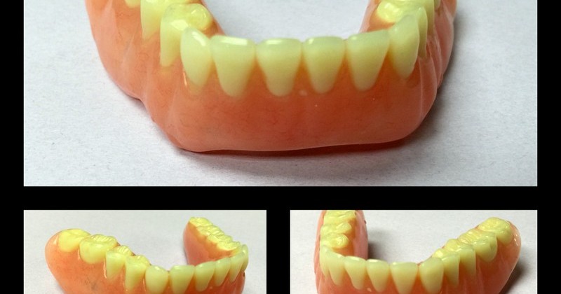 Tigard Dentist Explains Immediate Dentures